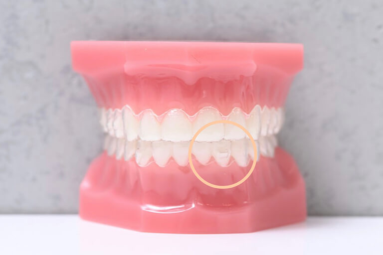 歯の移動の精緻なコントロールを可能にする「アタッチメント」